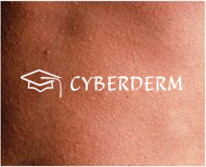 Urtikaria_Urtica (Quaddel)