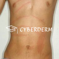 Urtikaria_Urtica (Quaddel)