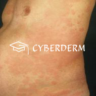 Urtikaria_Urtica (Quaddel)