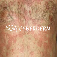 Urtikaria_Urtica (Quaddel)