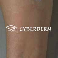 Urtikaria_Urtica (Quaddel)