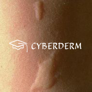 Urtikaria_Urtica (Quaddel)_372