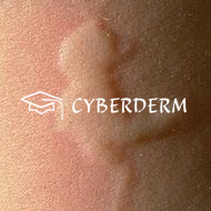 Urtikaria_Urtica (Quaddel)_36111_Urtica (Quaddel)