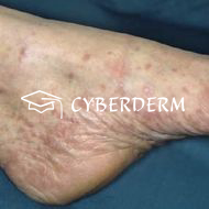 Lichen (ruber) planus