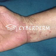 Lichen (ruber) planus