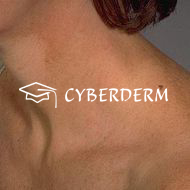 Lichtdermatosen