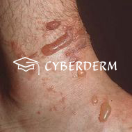 Lichtdermatosen