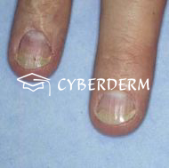 Nageldystrophien