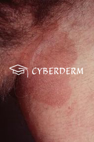 Erythrasma