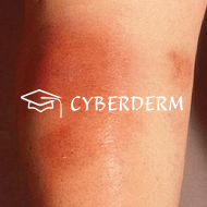 Erythema nodosum