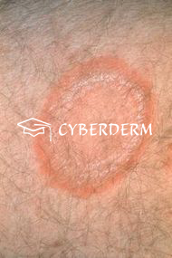 Dermatophytosen