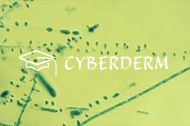 Dermatophytosen