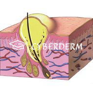 Pustula (Pustel)