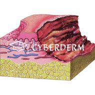 Ulcus (Ulkus)_Excoriatio (Exkoriation)_Erosio (Erosion)