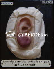 Lymphadenosis cutis benigna