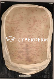 Arzneimittelexanthem