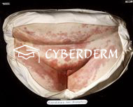 Candidiasis