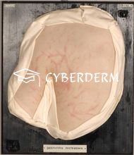Dermatophytosen