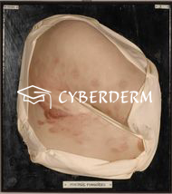 Dermatophytosen