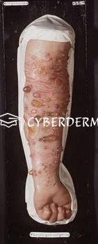 Bullöses Pemphigoid