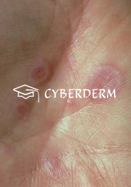 Toxische epidermale Nekrolyse