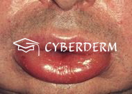 Angioödem_3610