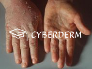 Allergische Kontaktdermatitis_3617_371