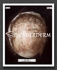 Dermatophytosen