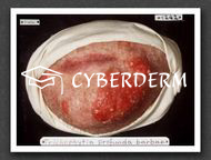 Dermatophytosen
