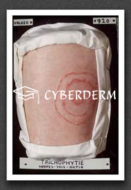 Dermatophytosen