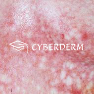 Radiodermatitis