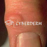 Erythema nodosum