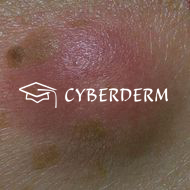 Erythema nodosum