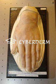 Atopische Dermatitis