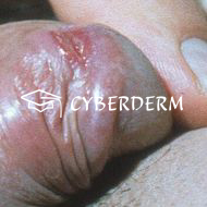 Lymphogranuloma venereum