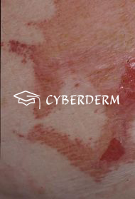 Radiodermatitis