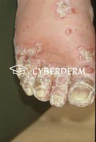Psoriasis