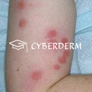 Stichreaktionen, verursacht durch Arthropoden