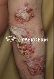 Psoriasis