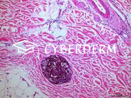 Hautmetastasen extrakutaner Neoplasien
