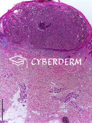 Hautmetastasen extrakutaner Neoplasien