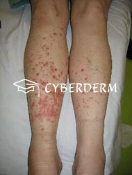Allergische Vaskulitis