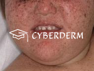 Xeroderma pigmentosum