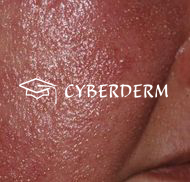 Atopische Dermatitis