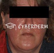 Allergische Kontaktdermatitis