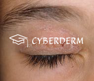 Atopische Dermatitis