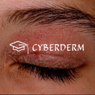 Atopische Dermatitis