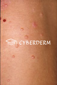 Molluscum contagiosum