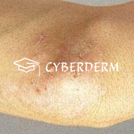 Dermatitis herpetiformis Duhring