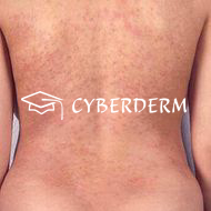 Dermatitis herpetiformis Duhring